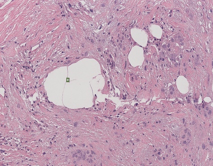 Module 3 WSI-Based Glioma Subtype Diagnosis